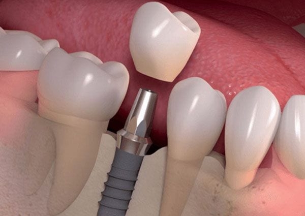 Trồng răng Implant Hàn Quốc có tốt không ? - Nha Khoa ArtDentist