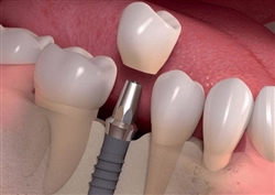 Thủ tục nhập khẩu chân trụ răng (trụ implant) năm 2023